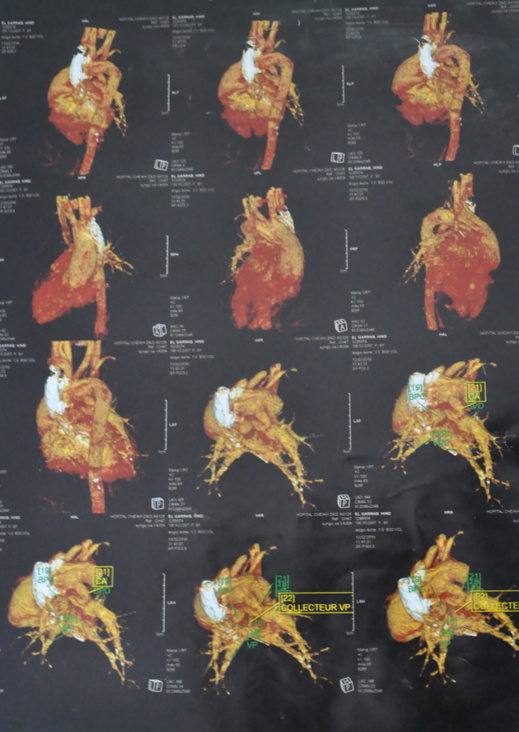 نداء إنساني عاجل لإنقاذ الطفلة "هند" في حاجة إلى عملية جراحية مستعجلة على مستوى القلب نداء إنساني عاجل لإنقاذ الطفلة "هند" في حاجة إلى عملية جراحية مستعجلة على مستوى القلب