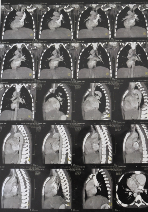 نداء إنساني عاجل لإنقاذ الطفلة "هند" في حاجة إلى عملية جراحية مستعجلة على مستوى القلب نداء إنساني عاجل لإنقاذ الطفلة "هند" في حاجة إلى عملية جراحية مستعجلة على مستوى القلب