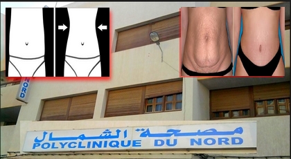 لأول مرة بالناظور.. طبيبة مختصة في الجراحة التجميلية "شفط الدهون" بمصحة الشمال لأول مرة بالناظور.. طبيبة مختصة في الجراحة التجميلية "شفط الدهون" بمصحة الشمال