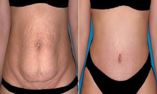 لأول مرة بالناظور.. طبيبة مختصة في الجراحة التجميلية "شفط الدهون" بمصحة الشمال