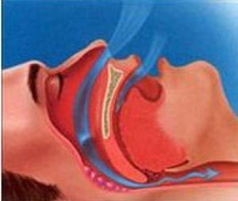 أسباب انسداد الأنف والشخير المزعج أسباب انسداد الأنف والشخير المزعج