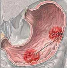 ما هي مسببات قرحة المعدة؟ ما هي مسببات قرحة المعدة؟