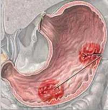 ما هي مسببات قرحة المعدة؟