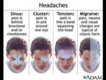 أنواع الصداع أنواع الصداع