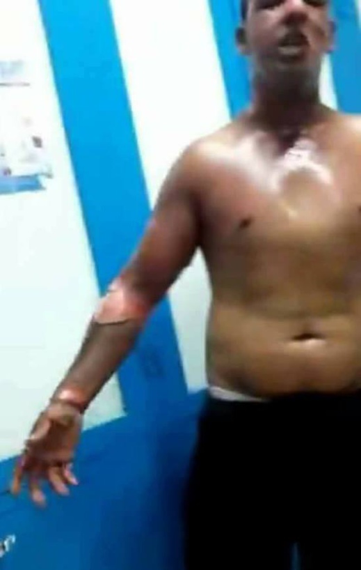 هكذا أصبحت حالة الشاب الذي أصيب بحروق متفاوتة الخطورة خلال مطاردة سلطات الناظور للفراشة هكذا أصبحت حالة الشاب الذي أصيب بحروق متفاوتة الخطورة خلال مطاردة سلطات الناظور للفراشة