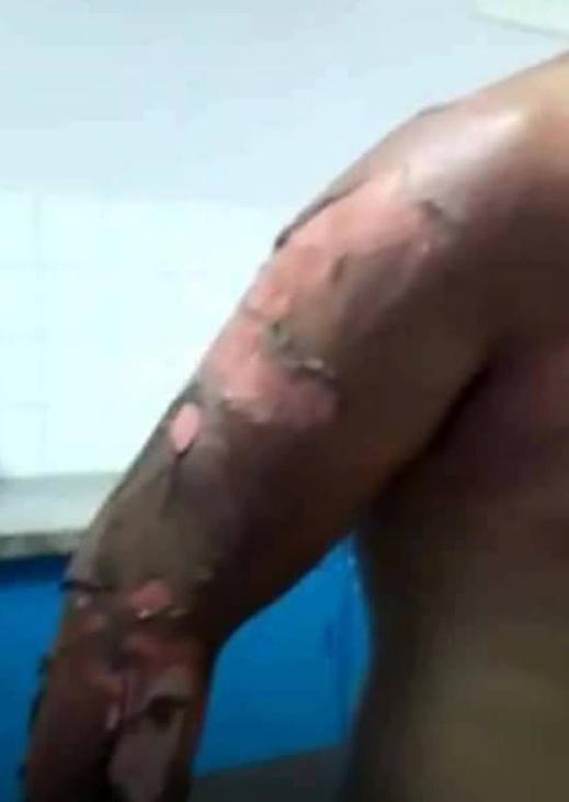 هكذا أصبحت حالة الشاب الذي أصيب بحروق متفاوتة الخطورة خلال مطاردة سلطات الناظور للفراشة هكذا أصبحت حالة الشاب الذي أصيب بحروق متفاوتة الخطورة خلال مطاردة سلطات الناظور للفراشة