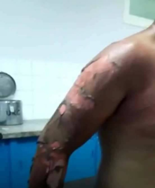 هكذا أصبحت حالة الشاب الذي أصيب بحروق متفاوتة الخطورة خلال مطاردة سلطات الناظور للفراشة هكذا أصبحت حالة الشاب الذي أصيب بحروق متفاوتة الخطورة خلال مطاردة سلطات الناظور للفراشة