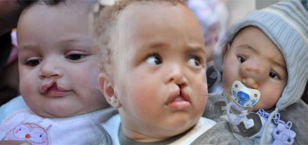 عملية بسمة تستقطب عشرات الأطفال إلى المستشفى الحسني بالناظور عملية بسمة تستقطب عشرات الأطفال إلى المستشفى الحسني بالناظور