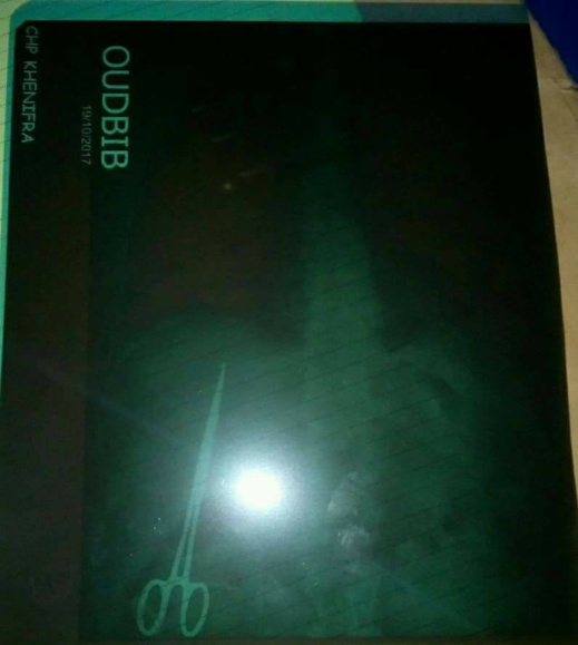 بالصور.. فضيحة تهز قطاع الصحة بالمغرب.. العثور على مقص داخل صدر مريض أجرى عملية قبل 10 سنوات بالصور.. فضيحة تهز قطاع الصحة بالمغرب.. العثور على مقص داخل صدر مريض أجرى عملية قبل 10 سنوات