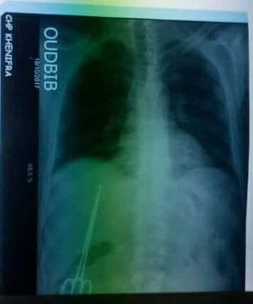 بالصور.. فضيحة تهز قطاع الصحة بالمغرب.. العثور على مقص داخل صدر مريض أجرى عملية قبل 10 سنوات