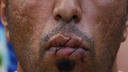 طالب لجوء مغربي بفرنسا يخيط فمه في شكل إحتجاجي غير مسبوق لهذا السبب طالب لجوء مغربي بفرنسا يخيط فمه في شكل إحتجاجي غير مسبوق لهذا السبب