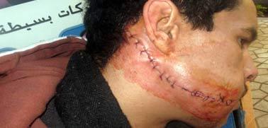 شخص يرتق خده بـ21 غرزة.. ويطالب بـ120 درهما