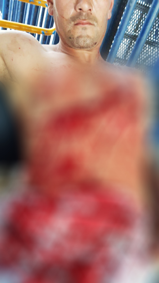 نقل مغربي إلى مستشفى مليلية على وجه السرعة إثر الاعتداء عليه في معبر باريو تشينو نقل مغربي إلى مستشفى مليلية على وجه السرعة إثر الاعتداء عليه في معبر باريو تشينو