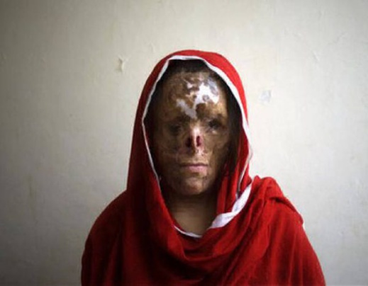 صورة.. تشويه وجه قاصر مغربي ب”الماء القاطع” في مدينة سرقسطة يثير إستياء عارما في أوساط الجالية
