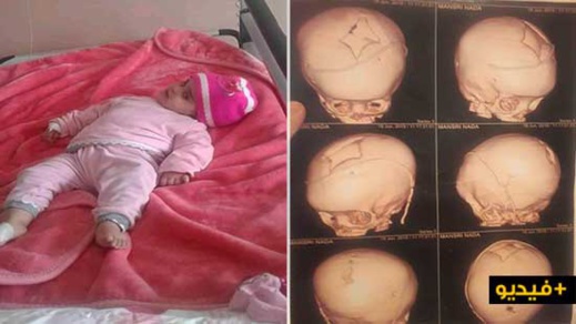 الطفلة "ندى" تناشدكم مساعدتها على توفير مصاريف التطبيب لعلاجها من مرض عضال