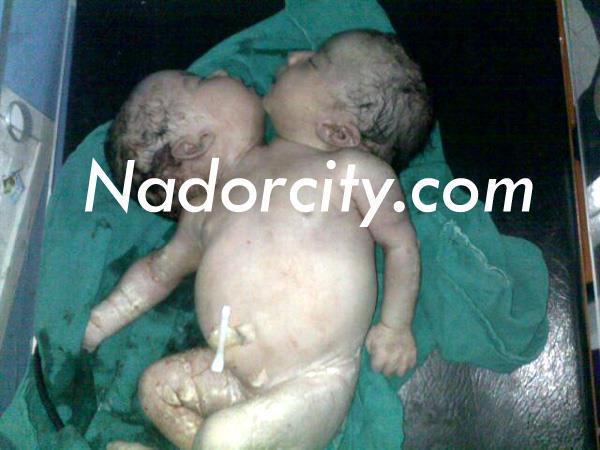 طفلة تولد برأسين بالناظور طفلة تولد برأسين بالناظور