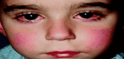 الجزائر تسجل أولى الإصابات بمرض نادر مرتبط بـ"كورونا" الجزائر تسجل أولى الإصابات بمرض نادر مرتبط بـ"كورونا"