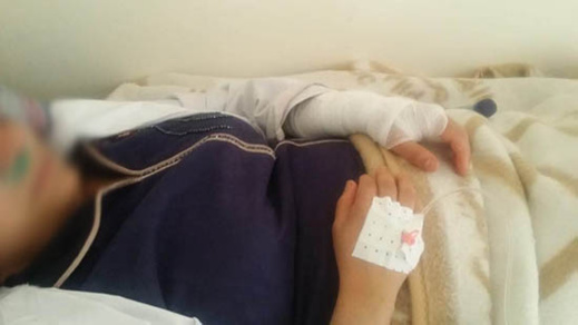 نقابة تنشر صورآثار الضرب الذي تعرضت له "قابلة" بالمركز الصحي أزلاف وتندد بالإعتداء عليها