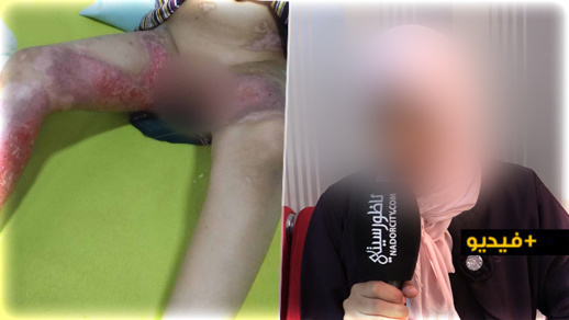 والدة طفلة أصيبت بحروق خطيرة تناشد محسني الناظور مساعدتها على علاج ابنتها والدة طفلة أصيبت بحروق خطيرة تناشد محسني الناظور مساعدتها على علاج ابنتها