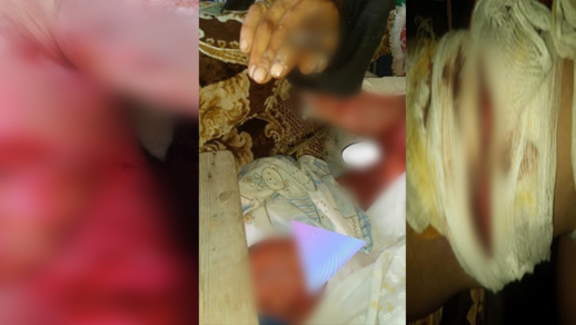 سيدة ناظورية تعرضت لحروق "خطيرة" تناشد المحسنين مساعدتها على العلاج سيدة ناظورية تعرضت لحروق "خطيرة" تناشد المحسنين مساعدتها على العلاج