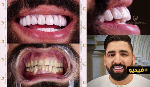 شاهدوا كيف غيرت عيادة الشلالي ابتسامة الفنان الكوميدي بوزيان بعد نجاح هوليود سمايل شاهدوا كيف غيرت عيادة الشلالي ابتسامة الفنان الكوميدي بوزيان بعد نجاح هوليود سمايل