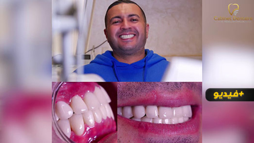 الدكتور عبد الله الشلالي يحقق حلم مهاجر هولندي في الحصول على هوليود سمايل الدكتور عبد الله الشلالي يحقق حلم مهاجر هولندي في الحصول على هوليود سمايل