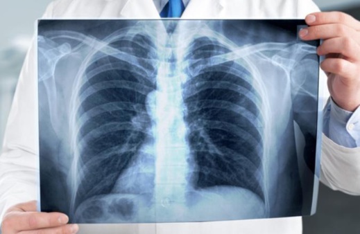 هذه خطة وزارة الصحة لمحاربة داء السل هذه خطة وزارة الصحة لمحاربة داء السل