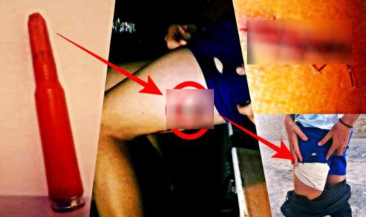 بالصور.. الشرطة الإسبانية تصيب قاصر مغربي بالرصاص