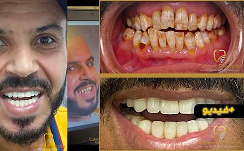 شاهدوا.. عيادة الدكتور شلالي عبد الله تحول الناظور إلى قبلة للباحثين عن ابتسامة المشاهير شاهدوا.. عيادة الدكتور شلالي عبد الله تحول الناظور إلى قبلة للباحثين عن ابتسامة المشاهير