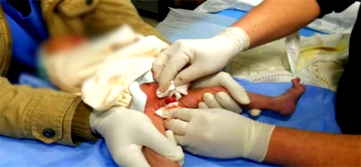 عائلة طفل تكشف تفاصيل عملية ختان ابنهم على يد طبيب ناظوري معروف تحولت إلى رحلة جحيم مأساوية