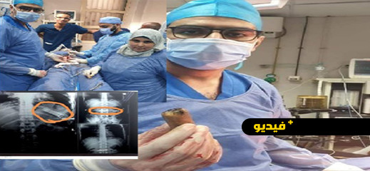 شوفوا هاد الحمق: مصري أكل هاتفا ونسيه في معدته 6 أشهر