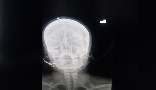 يدق مسمارا في جمجمة امرأة حامل لكي تضع مولودا ذكر يدق مسمارا في جمجمة امرأة حامل لكي تضع مولودا ذكر