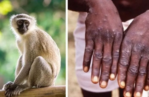 بسبب فيروس "جدري القرود".. بلجيكا تفرض الحجر الصحي بسبب فيروس "جدري القرود".. بلجيكا تفرض الحجر الصحي