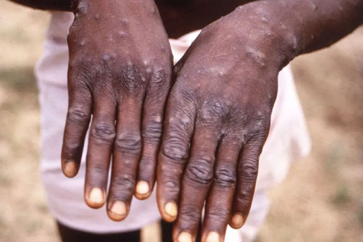 تطوير فحوص PCR للكشف عن الإصابة بفيروس جدري القرود