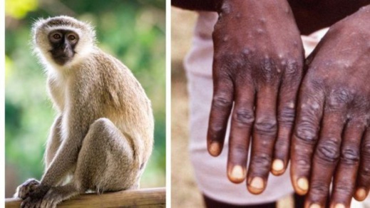 16حالة جديدة من جدري القرود تظهر بالمملكة المتحدة 16حالة جديدة من جدري القرود تظهر بالمملكة المتحدة