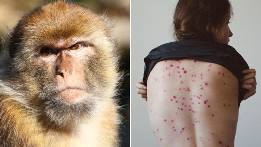 وزارة الصحة تسجل أول حالة إصابة مؤكدة بجدري القرود