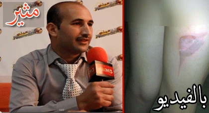 طليقة تُعذّب ابنها القاصر وتَكْويهِ بواسطة آلة "البْلانْتشَا" في أنحاء من جسمه طليقة تُعذّب ابنها القاصر وتَكْويهِ بواسطة آلة "البْلانْتشَا" في أنحاء من جسمه