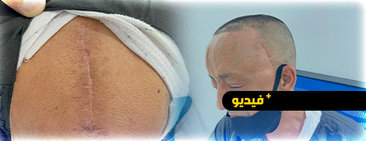 شخص من الناظور يفقد سمعه بعد إجراء 6 عمليات لنزع الأورام ويناشد القراء مساعدته شخص من الناظور يفقد سمعه بعد إجراء 6 عمليات لنزع الأورام ويناشد القراء مساعدته