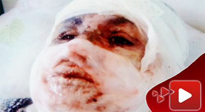 مؤثر.. سيدة مطلقة أبت إقامة علاقة مع شخص فأشعل النار في جسدها مؤثر.. سيدة مطلقة أبت إقامة علاقة مع شخص فأشعل النار في جسدها