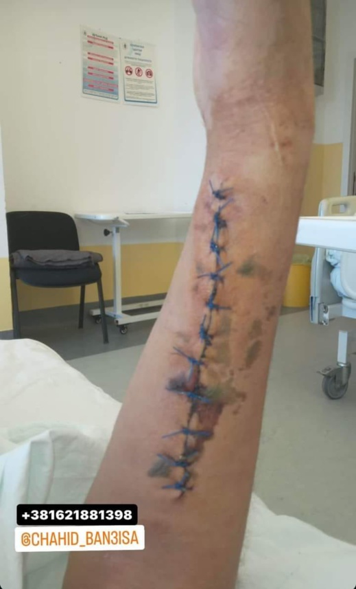 شهيد بحاجة للمساعدة.. مهاجر مغربي يعيش العذاب في صربيا بعد بتر الجيش لساقيه شهيد بحاجة للمساعدة.. مهاجر مغربي يعيش العذاب في صربيا بعد بتر الجيش لساقيه