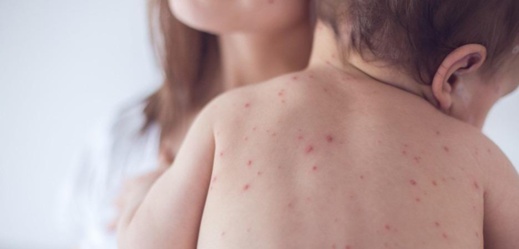 وزارة الصحة تسجل ارتفاعا ملحوظا في حالات الإصابة ب "بوحمرون" بالمملكة وزارة الصحة تسجل ارتفاعا ملحوظا في حالات الإصابة ب "بوحمرون" بالمملكة