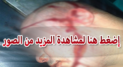 مجهولون يُشرملون وجه شابّ تطلّب إحداث 133 غرزة قبل أن يسلبوه 3 مليون سنتيم بأزغنغان