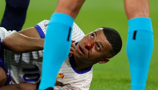 كيليان مبابي يصاب بكسر في أنفه كيليان مبابي يصاب بكسر في أنفه