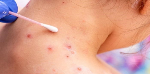 بعد إعلان حالة الطوارئ عالميا.. وزارة الصحة نتابع عن كثب الوضع الوبائي لانتشار جذري القردة بعد إعلان حالة الطوارئ عالميا.. وزارة الصحة نتابع عن كثب الوضع الوبائي لانتشار جذري القردة