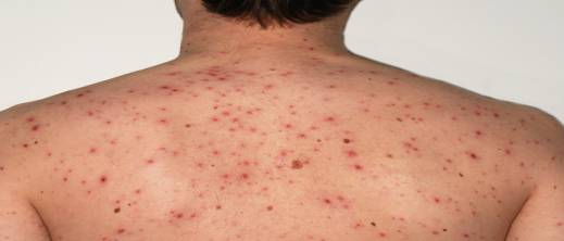 مخاوف من خطر تفشي مخاوف من خطر تفشي