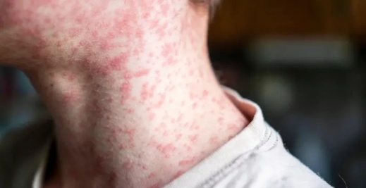 بعد تفشي بوحمرون.. هل تلجأ وزارة التربية الوطنية لتمديد العطلة؟ بعد تفشي بوحمرون.. هل تلجأ وزارة التربية الوطنية لتمديد العطلة؟