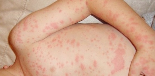 مدينة مغربية تتحول إلى بؤرة كبيرة لداء "بوحمرون" مدينة مغربية تتحول إلى بؤرة كبيرة لداء "بوحمرون"