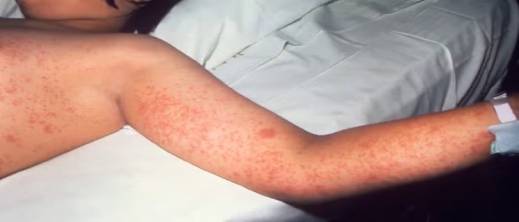 بعد المغرب.. تفشي الحصبة بعد المغرب.. تفشي الحصبة