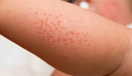 6 وفيات وأكثر من 3000 إصابة بسبب بوحمرون خلال أسبوع بالمغرب 6 وفيات وأكثر من 3000 إصابة بسبب بوحمرون خلال أسبوع بالمغرب