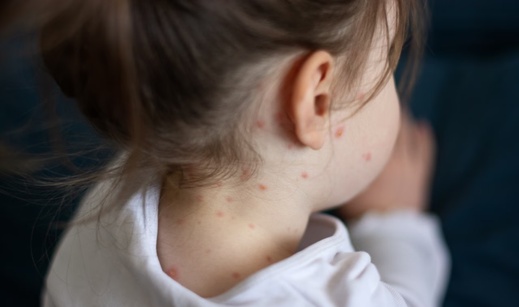 هولندا تسجل حالات إصابة ببوحمرون بعد انتقال العدوى أثناء التواجد في المغرب هولندا تسجل حالات إصابة ببوحمرون بعد انتقال العدوى أثناء التواجد في المغرب